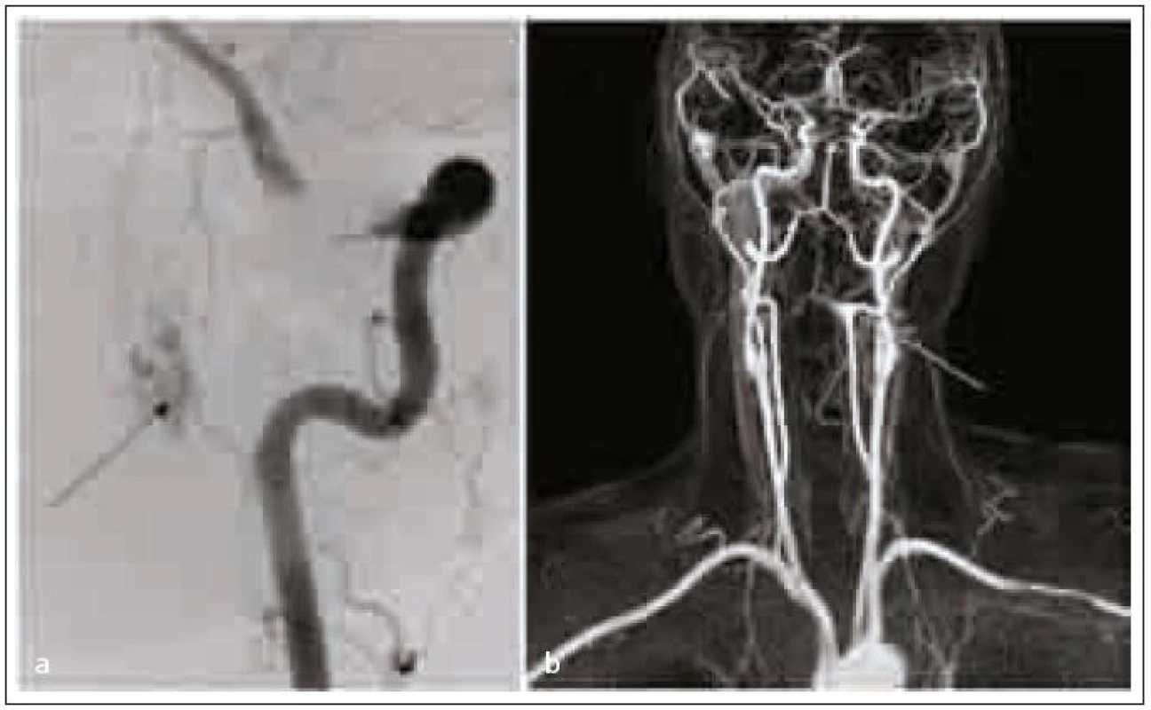 Kontrastní MR angiografie, šipka ukazuje na místo nidu AV malformace (a), DSA potvrzuje nález na MR angiografii (b).
