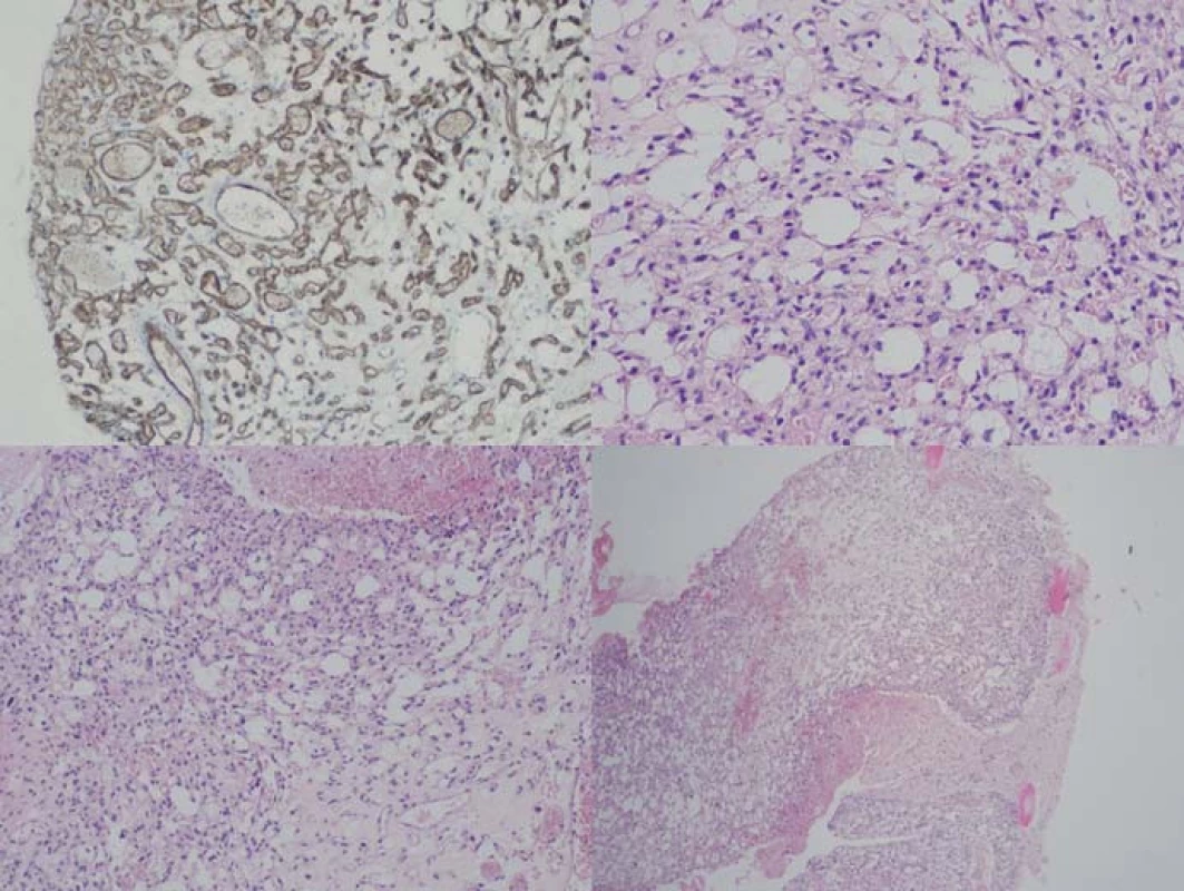 Histologický obraz hemangioblastomu.