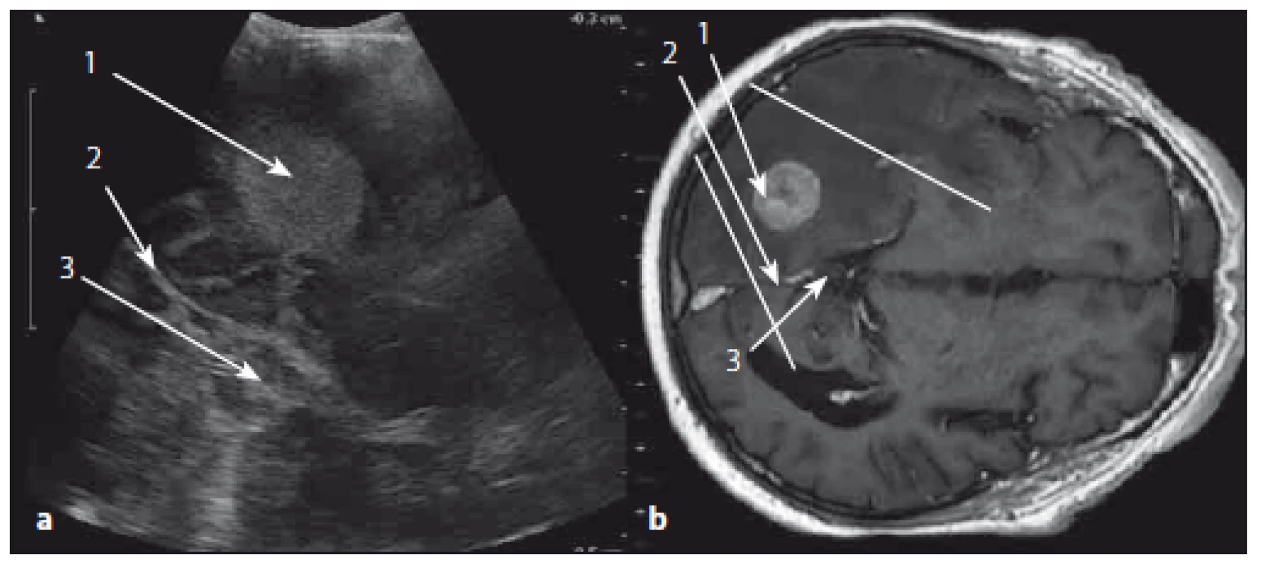Metastáza okcipitálního laloku vlevo v sonografickém a MR T1W obraze.
Fig. 11. Metastasis of the left occipital lobe in ultrasound and MRI T1W images.