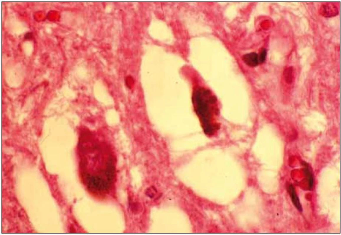 Regresivní změny melanoticky pigmentovaných neuronů v substantia nigra.
Barvení hematoxilin eozin.