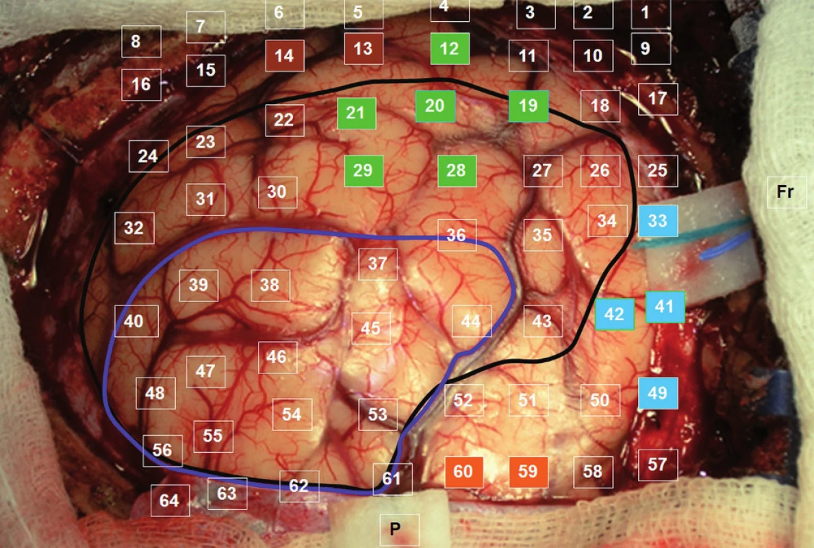 Fotografie odhaleného kortexu se zaznamenáním polohy jednotlivých svodů: tmavě modrá – rozsah parciální resekce; černá – kortikální hranice tumoru dle navigace; barevné označení elektrod v oblastech s pozitivními odpověďmi na stimulaci (odpovídá obr. 1).