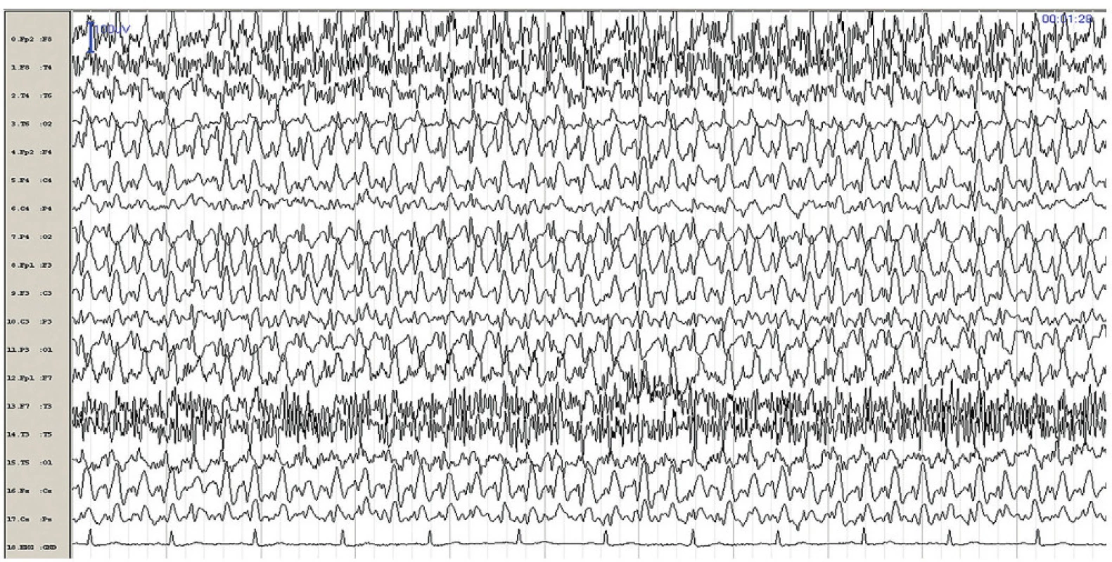 EEG záznam pořízený během amentního stavu, kdy pacientka reagovala na vnější podněty, nicméně její reakce byly zatíženy chybami a někdy byly zcela neadekvátní. Na EEG kontinuální generalizované symetrické synchronní SW komplexy 3–4 Hz.