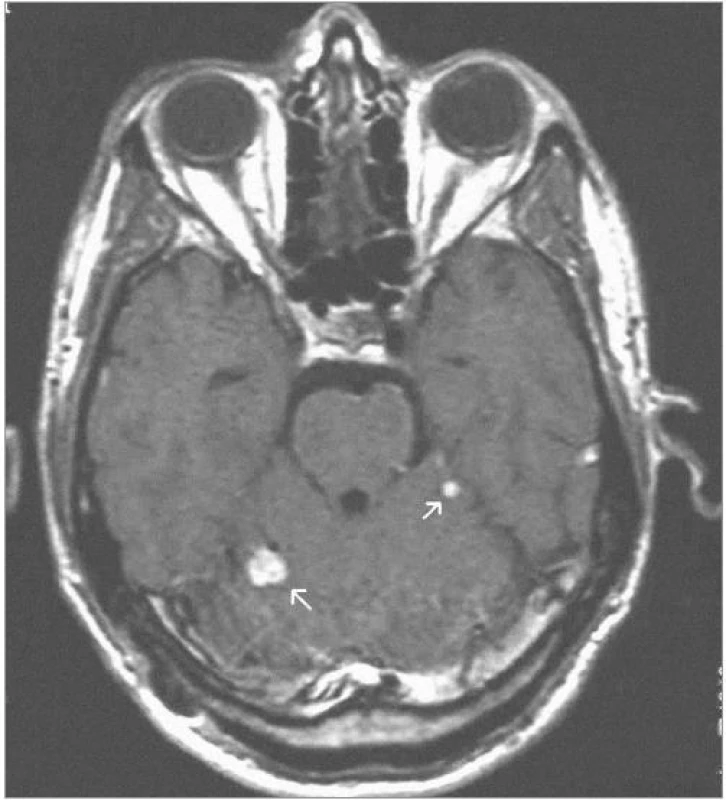 2 hemangioblastomy zadní jámy lební – centrační MRI – SE (sekvence) T1-vážený obraz po aplikaci kontrastní látky – před iradiací gama nožem (2001).