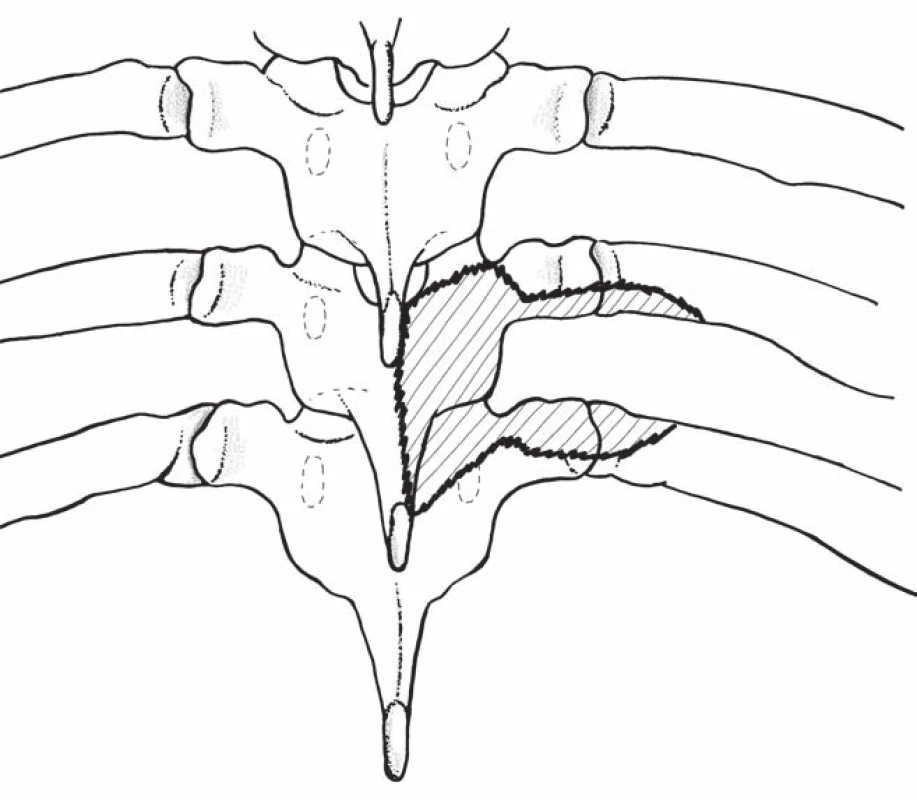 Nákres zadního operačního přístupu: hemilaminektomie s jednostranným odstraněním kloubu, částečná hemilaminektomie přilehlých oblouků, odstranění pediklu
a částečná kostotransversektomie (předozadní pohled).
Fig. 3. Drawing posterior surgical approach: hemilaminectomy with unilateral removing of the intervertebral joint, partial hemilaminectomy of the adjacent arches, and removing of the pedicle and partial costotransversectomy (antero-posterior view).