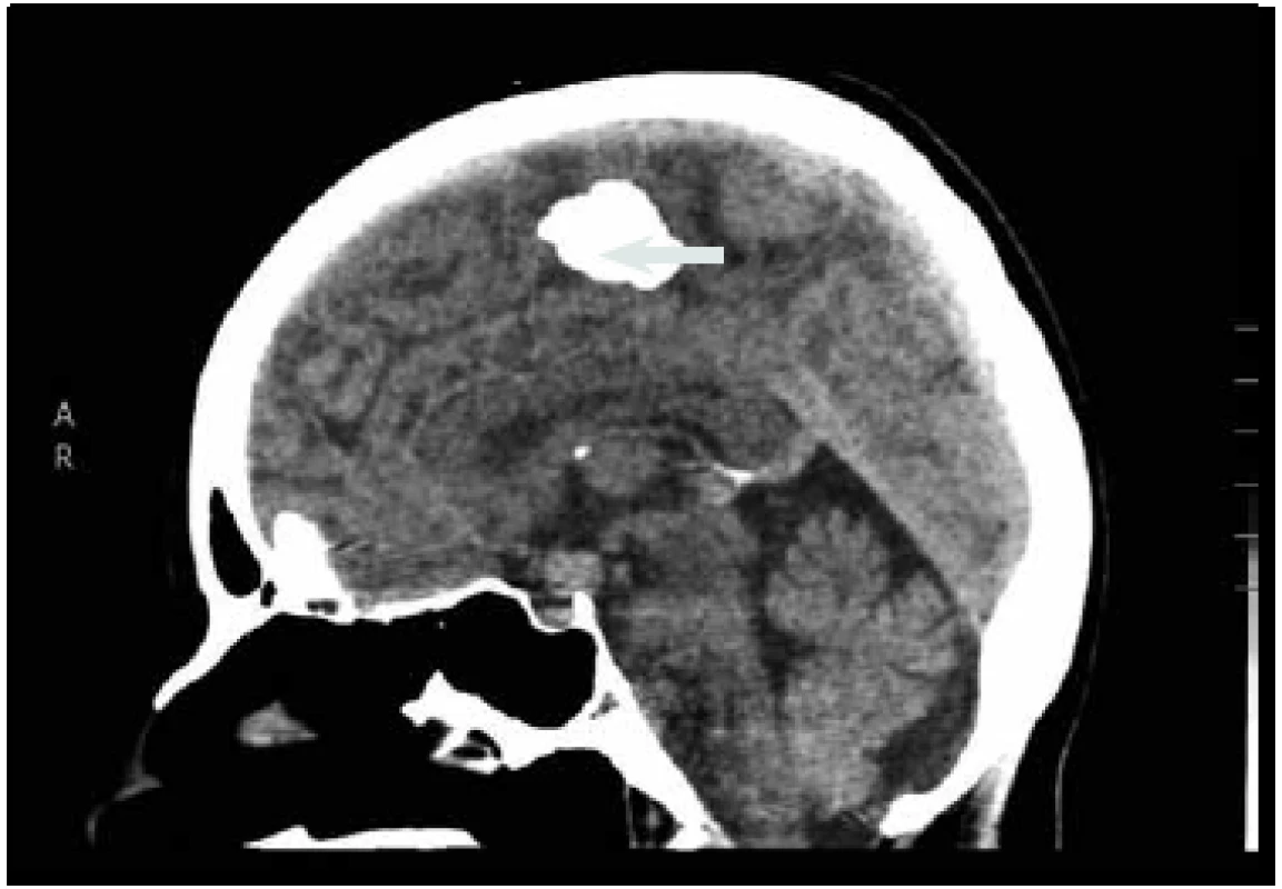 CT mozku (nativní, sagitální rekonstrukce). Okrouhlá supraselární tumorózní expanze (šipka), kalcifikace falxu.
Fig. 3. CT scan of the brain (sagittal scans without contrast). Apparent suprasellar tumor expansion (arrow), calcification of the falx.