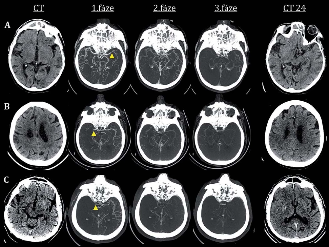 Hodnocení leptomeningeálních kolaterál pomocí protokolu multifázické CT angiografie, mCTA (obrazová dokumentace použita z databáze Kliniky zobrazovacích metod LF MU a FN u sv. Anny v Brně).