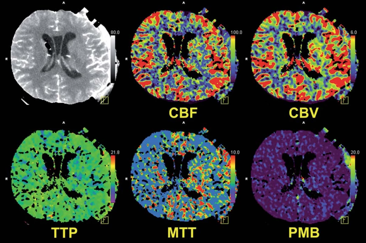 Perfuzní počítačová tomografie ukazuje fyziologickou mozkovou perfuzi.
