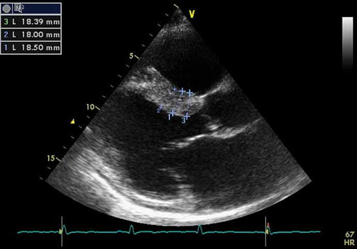 Echokardiografie pacienta s Fabryho chorobou: parasternální projekce na dlouhou osu v diastole – hypertrofie interventrikulárního septa s maximálním rozměrem až 18,5 mm, lehké zesílení cípů mitrální chlopně.
Fig. 4. Echocardiography of Fabry disease patient: parasternal long-axis view (PLAX) in diastole showing ventricular septum hypertrophy with maximal wall thickness of 18.5 mm, and mildly thickened mitral valve.