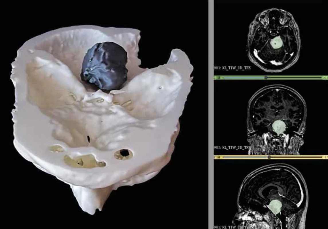 3D modeling petrokliválního meningeomu.