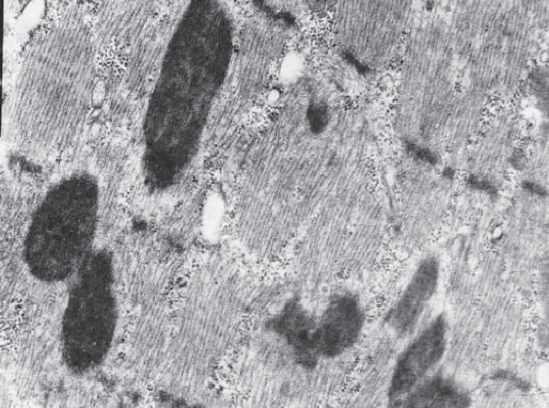 V elektronovém mikroskopu byly zastiženy inkluze charakteru osmiofilních tyčinkovitých tělísek. Tyčinkovité inkluze byly uloženy většinou v podélné ose vlákna a měly protáhlý doutníkový tvar. Inkluze byly výrazně elektrondenzní a byly uloženy často v oblasti Z – disků sarkomer. Zvětšení 12 000krát.