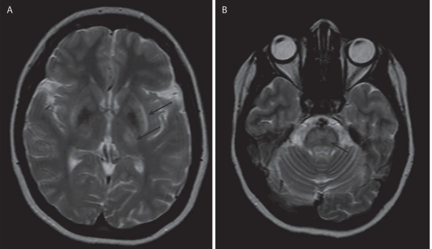 Příklad současného postižení bazálních ganglií a mozkového kmene u jednoho pacienta.
Obr. 2a) Šipky označují hyperintenzity v thalamu, striatu a claustru spolu s hypointenzními změnami v globus pallidus, T2 vážený obraz.
Obr. 2b) Šipka označuje hyperintenzní změny v pontu v T2 váženém obrazu.