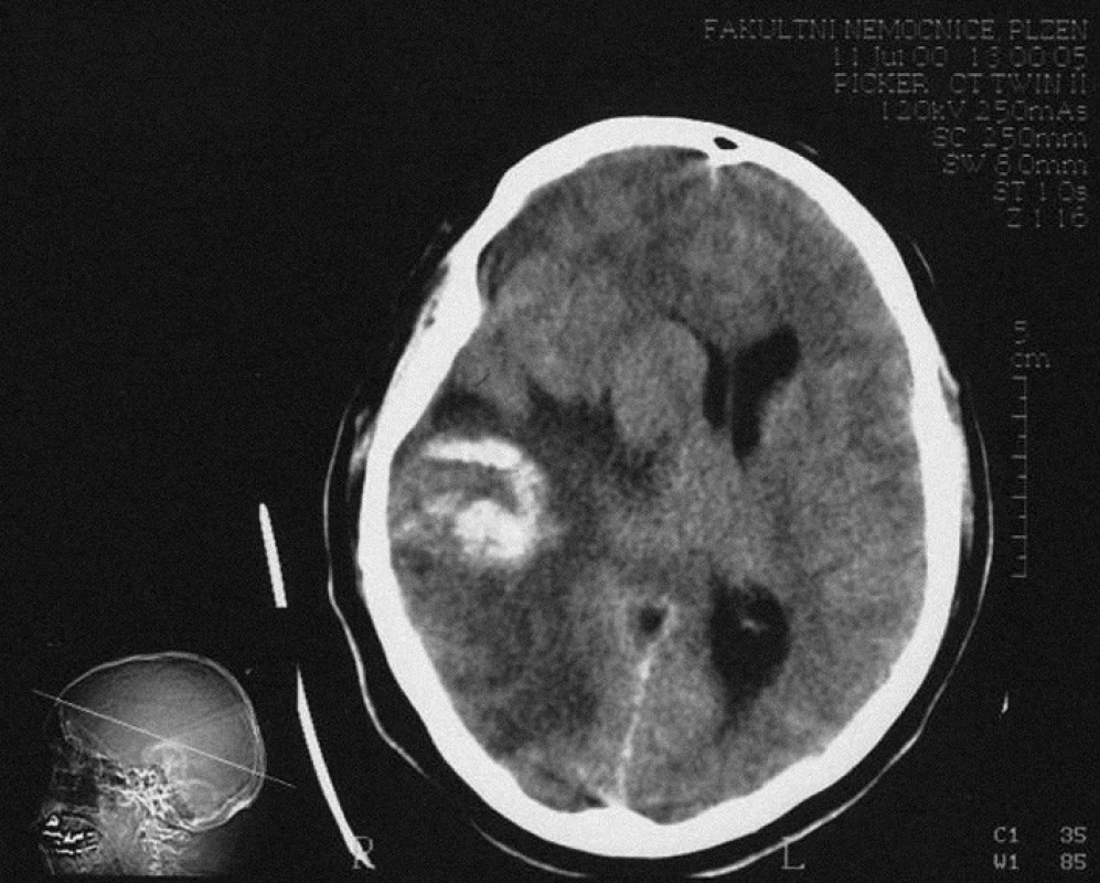 Na CT vyšetření mozku bezprostředně po úrazu je patrné nepravidelné hyperdenzní ložisko parietálně vpravo s edémem levé hemisféry. Přetlak středočárových strukturdoleva dosahuje 13,5 mm.