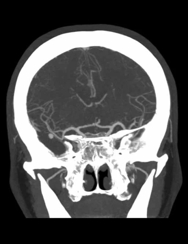 CT angiografie v koronárním řezu prokazuje aneuryzma arteria cerebri media v oblasti M2/3 vpravo velikosti 5 mm. Z CT zobrazení nelze výduť lokalizovat mimo vlastní větvení střední mozkové tepny.