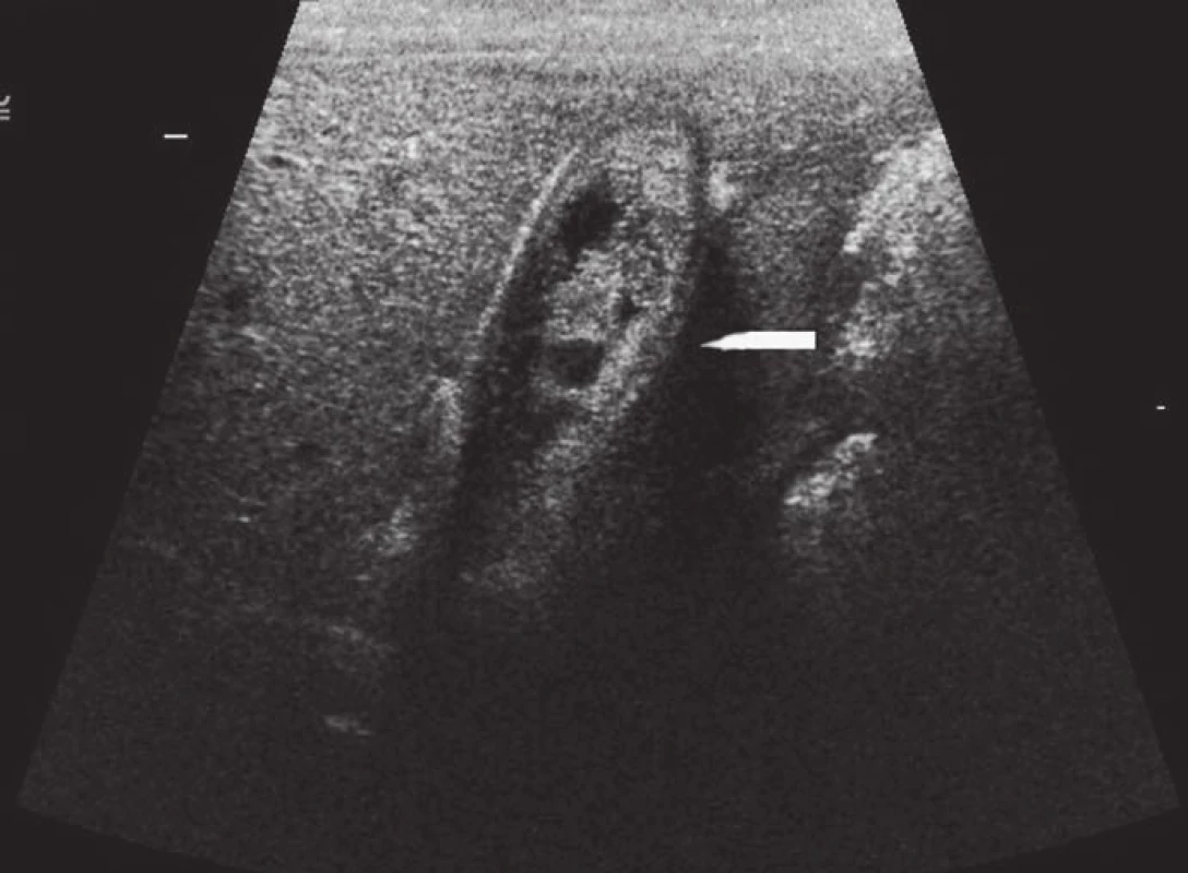 Tubulopapilární adenom.
Ultrazvukové vyšetření – žlučník vyplněný echogenními hmotami.
Fig. 1. Tubulopapillary adenoma.
Ultrasound examination – gallbladder filled with echogenic masses.