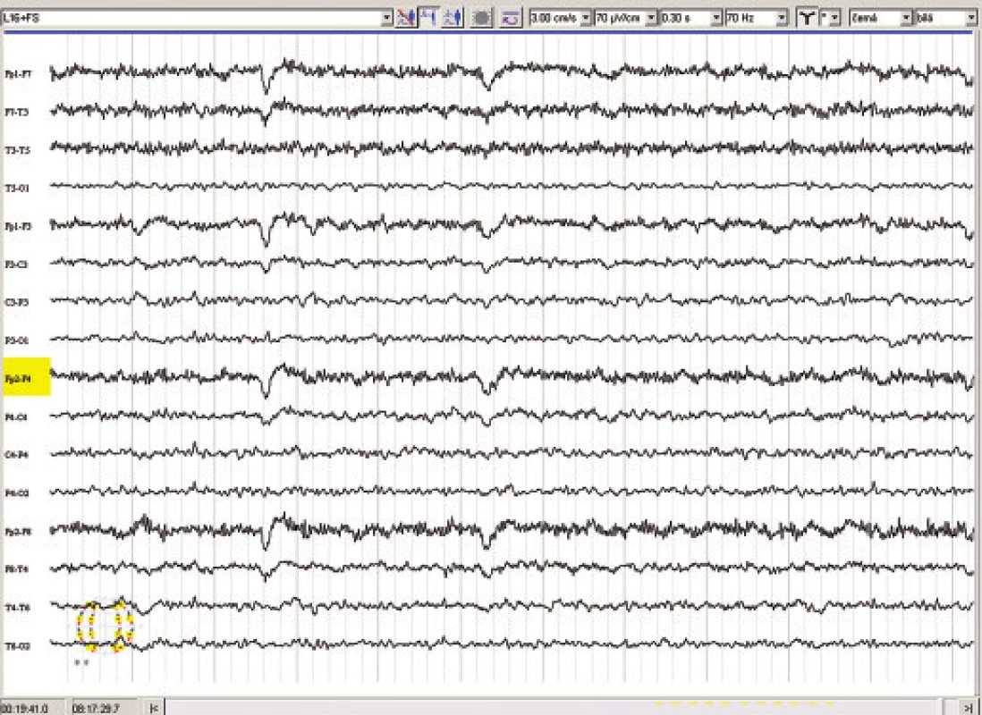 EEG v květnu 2007 (21 měsíců po ozáření Leksellovým gamma nožem).