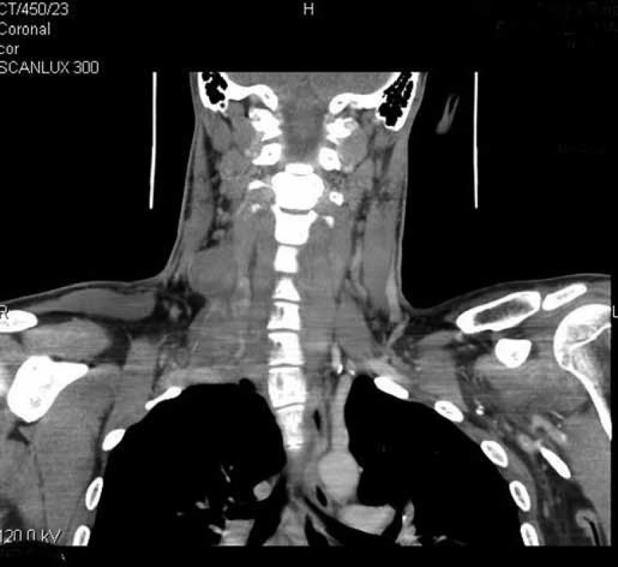 CT angiografie.
Kulovité ložisko v oblasti cervikálního plexu vpravo – koronární řez.