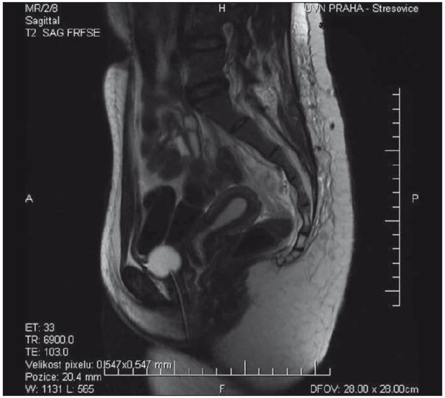 Pooperační MR kontrola po resekci 90 % presakrálně rostoucího ganglioneuromu v T2 váženém obraze.
