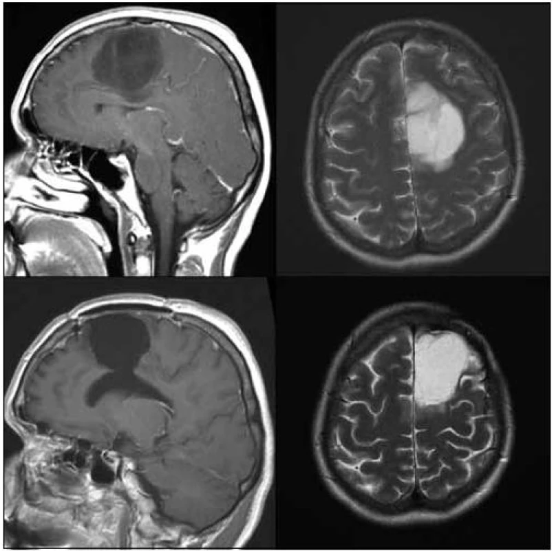 42letá pacientka po radikální &gt; 90% resekci oligoastrocytomu gr. II v oblasti gyrus frontalis superior, gyrus
cinguli a corpus callosum vlevo v roce 2007.