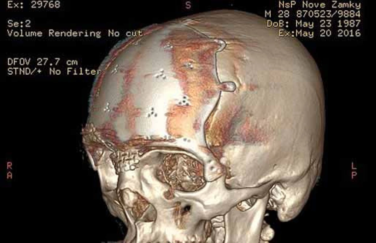 3D CT rekonštrukcia s titánovým implantátom a jeho uchytením frontodorzálne resp. v oblasti fronto-zygomatického spojenia.
Fig. 7. A 3D CT of a reconstruction with titanium implants and its anchoring within dorsofrontal and frontozygomatic area.
