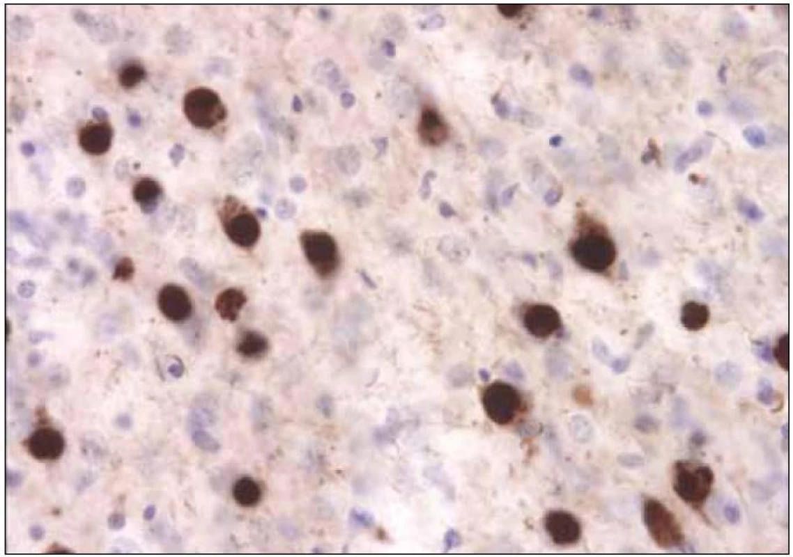 Typická tauopatie, v tomto případě frontotemporální demence, Pickova tělíska v neuronech jsou tvořena patologicky fosforylovanými tubuly tau proteinu.
&lt;sup&gt;©&lt;/sup&gt;Ústav patologie LF UP a FN Olomouc