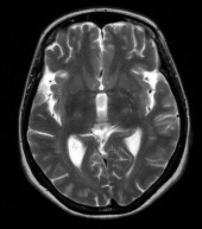 Pacientka s DM 1, 51 let. V axiálních FLAIR (a) a T2 vážených (b) obrazech jsou patrná ložiska zvýšeného signálu v bílé hmotě frontálních a parietálních laloků oboustranně. Rozšířené jsou Sylviovy rýhy při atrofii mozku (b).