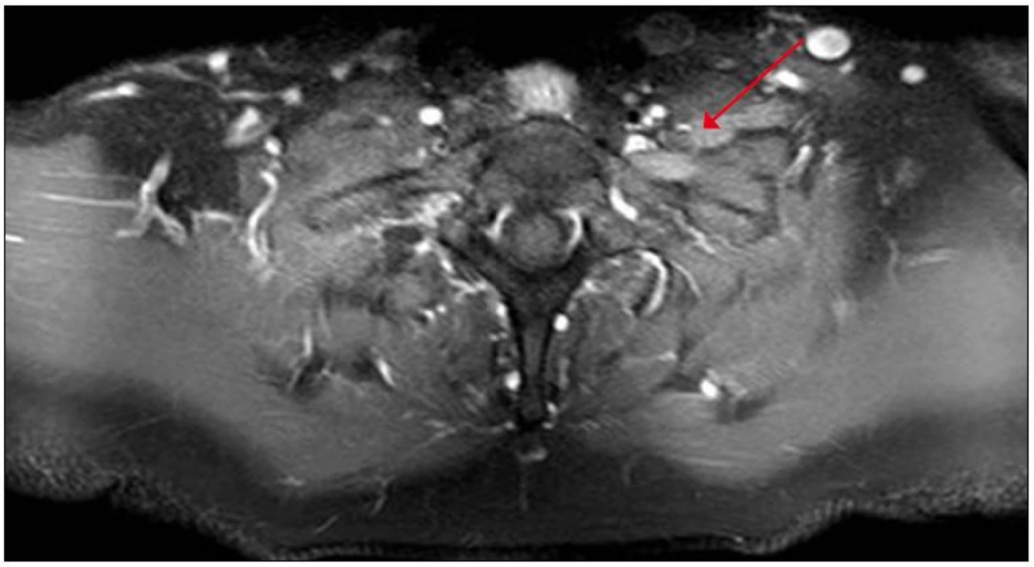 MR brachiálního plexu, postkontrastní zobrazení v axiální rovině s potlačením signálu tuku (T1 SPIR) – na levé straně je na příčném průřezu viditelné zesílení a postkontrastní sycení struktur brachiálního plexu.