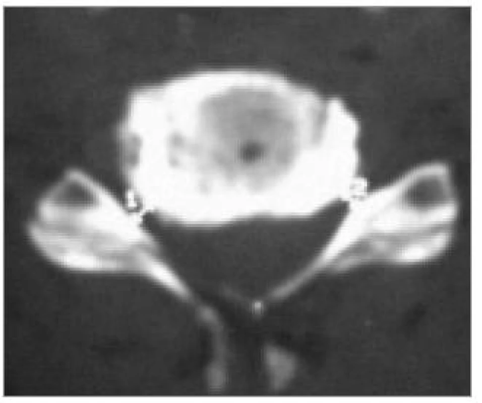 Osteofyty zúžená foramina bilaterálně: CT-axiální obraz.