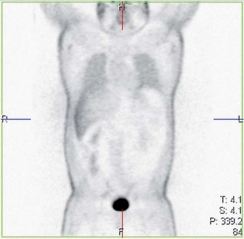 Celotělové PET/CT u nemocného se sarkoidózou indikované k vyloučení mimoplicního postižení (vyšetření z ledna 2009).
Fig. 2. Whole-body PET/CT in patient with sarcoidosis indicated to exclude the extrapulmonary involvement (January 2009).