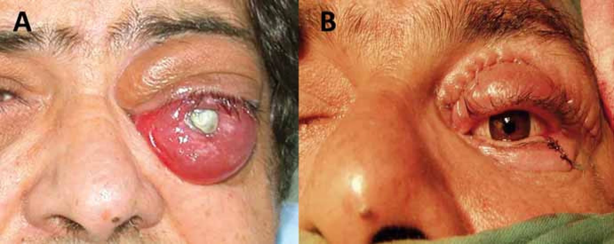 Enukleace bulbu v pozdní fázi meningeomu pochvy optického nervu pro bolestivý exoftalmus slepého oka (A) s následnou plastikou víček a implantací protézy (B).