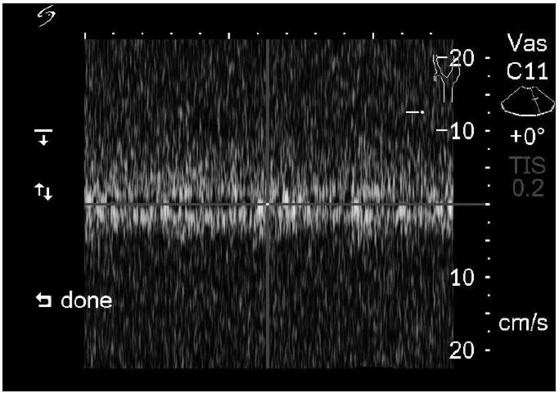 Ultrazvukové vyšetření v dopplerovském modu – obnovení průtoku v cerebrospinální junkci (rychlost toku likvoru 5 cm/s).