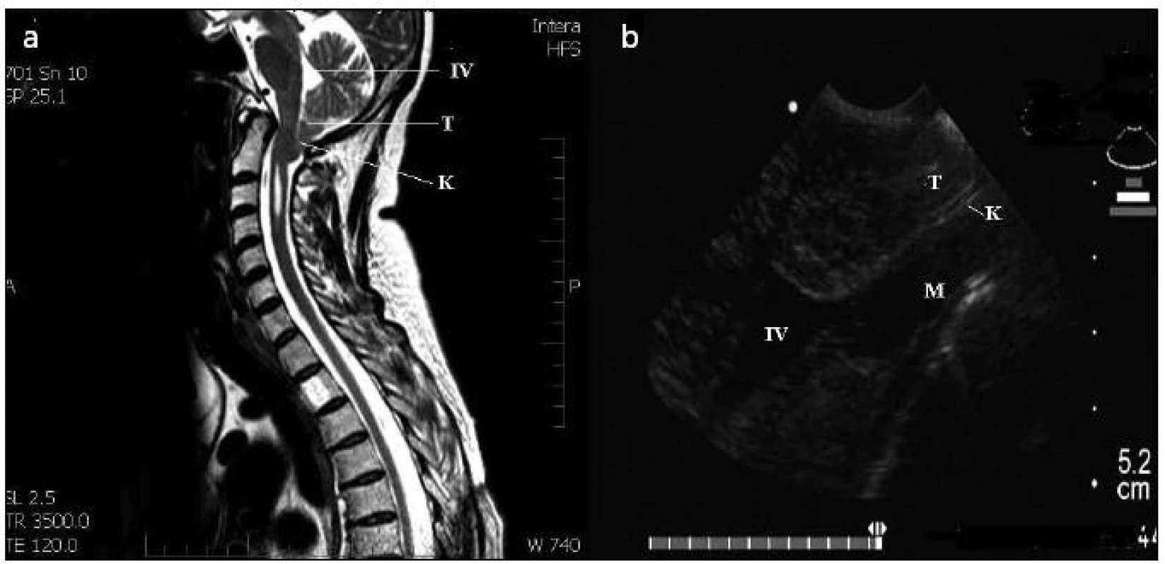 Chiariho malformace I typ A – předoperační MR T2, sagitální řez (1a) a peroperační ultrazvukové vyšetření v B obraze (1b).
T: mozečkové tonzily; M: mícha; IV: 4. komora; K: místo komprese