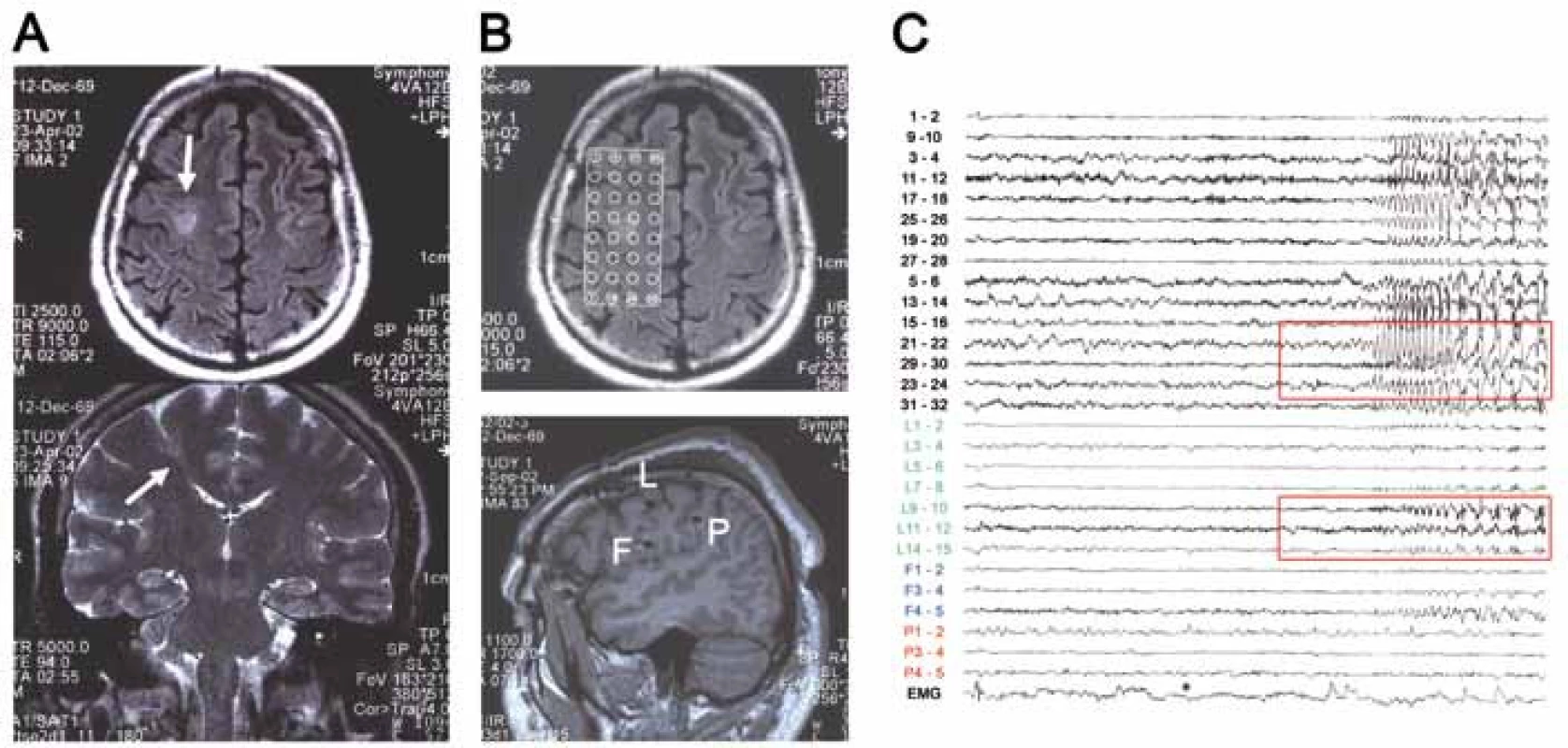 Invazivní EEG vyšetření u pacienta s lézí v sulcus precentralis vpravo.
A) předoperační MR (léze označena šipkou).
B) lokalizace intrakraniálních elektrod (kombinace subdurálního gridu s kontakty 1–32 + tří ortogonálně zavedených hlubokých elektrod – F, L a P)
C) iktální EEG záznam (počátek záchvatové aktivity označen v grafu barevně) (pacient 6).