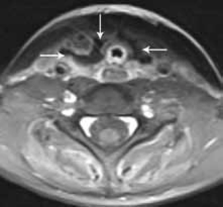 Kazuistika 2: MR krku, axiální rovina, T1 po aplikaci kontrastní látky.
Stav po tyreoidektomii, oboustranně ohraničené tekutinové kolekce v lůžku štítné žlázy (šipky).