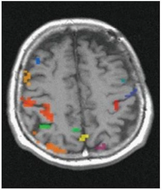 Vyšetření funkční MR po EC–IC bypassu – zlepšení aktivního kortexu vlevo.