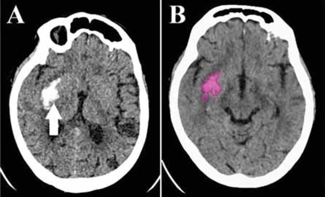 (A) Natívne vyšetrenie CT mozgu – typická intracerebrálna hemorágia v bazálnych gangliách vpravo (šípka). (B) Identický pacient, hemorágia v bazálnych gangliách vpravo z natívneho CT vyšetrenia identifi kovaná aj softvérom umelej inteligencie e- -ASPECTS Brainomix®, označená ružovou farbou. Softvérom stanovený objem hemorágie je 8 ml.