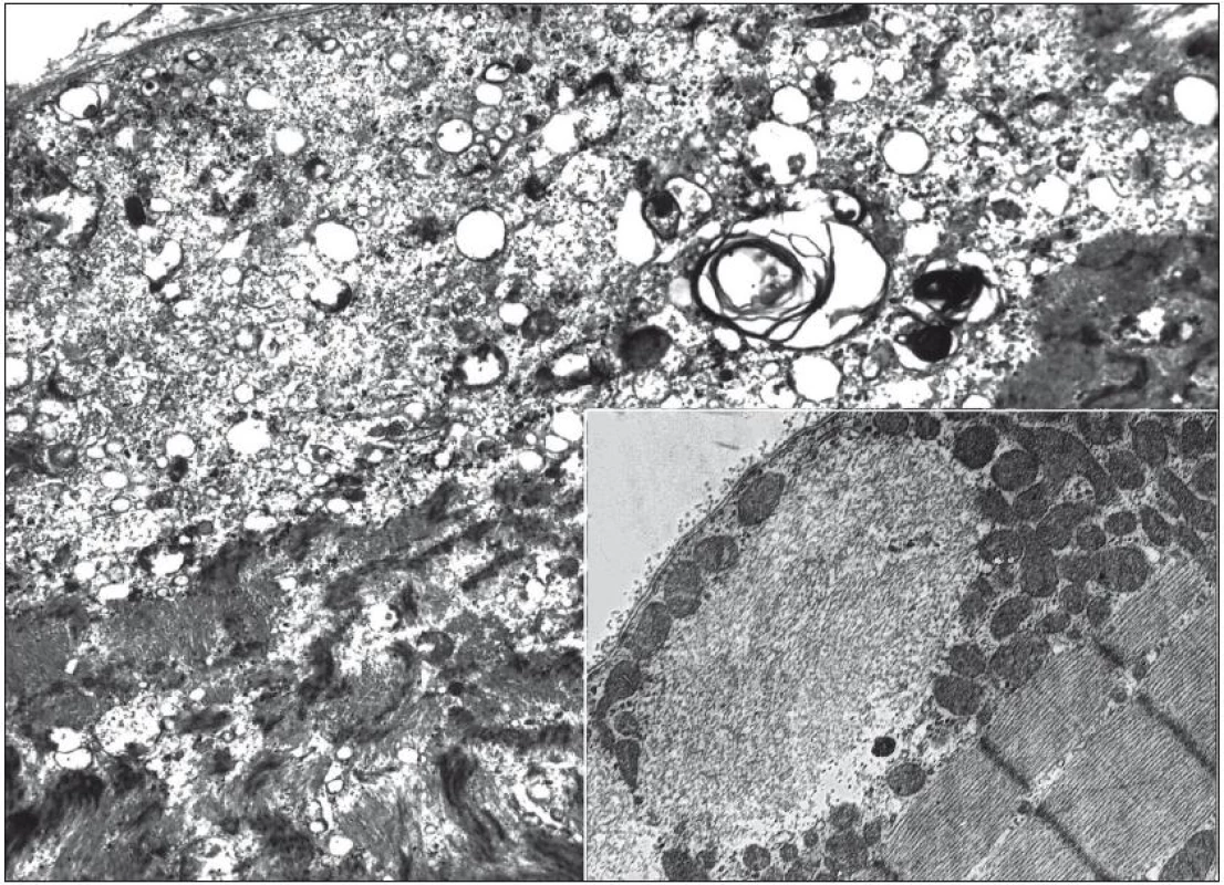 Elektronogram. Granulární materiál a membranózní víry v oblasti lemované vakuoly (zvětšení 5 000×). Výřez: subsarkolemální tubulofilamentózní inkluze (zvětšení 300×).
