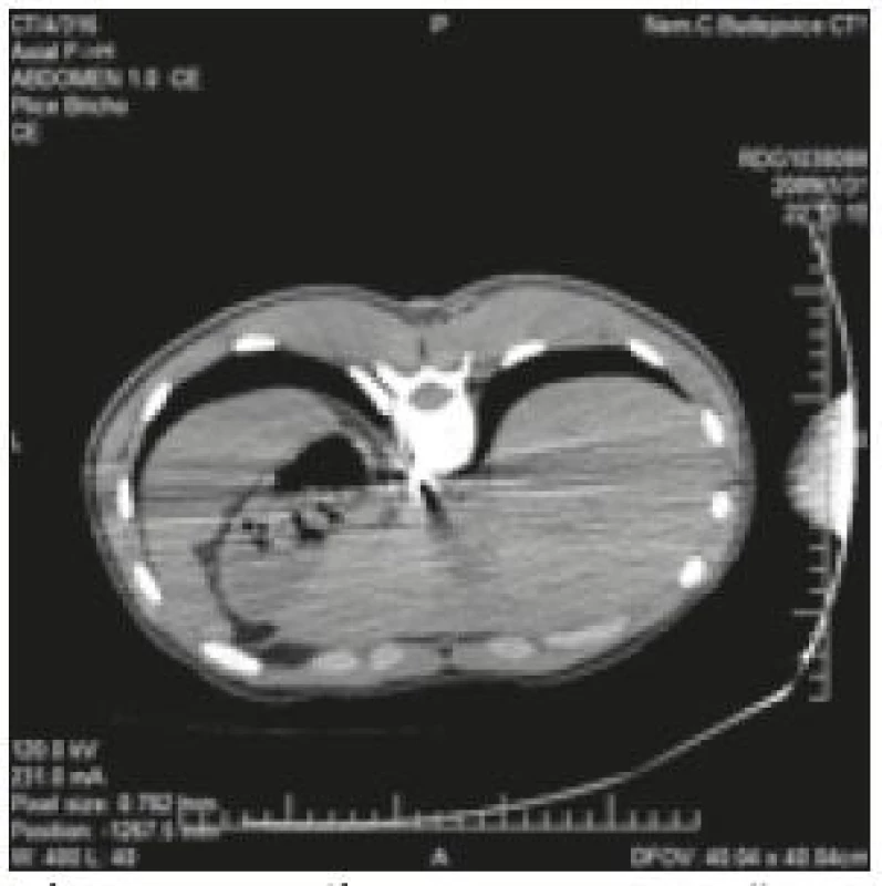 Na axiálním CT je patrné, že se hrot nože dotýkal dorzální stěny hrudní aorty.
