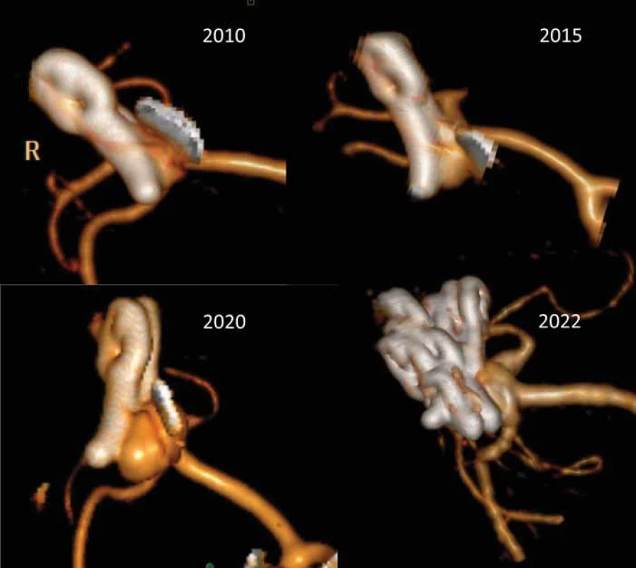 3D CT rekonstrukce 1 rok po klipu prasklého aneuryzmatu arteria cerebri media vpravo (2010). Ponechán „nájezd“ pro odstup M2 větví, které odstupovaly z báze vaku. Pacientka byla sledována, kontrolní CTA po 6 (2015) a 11 letech (2020) demonstrovala postupnou progresi vaku. V roce 2020 jsme provedli operaci a progredující recidivu vaku uzavřeli 2 okénkovými klipy přes klipy původní z roku 2010, jak je patrno na kontrolní 3D CTA 2 roky po operaci recidivy.