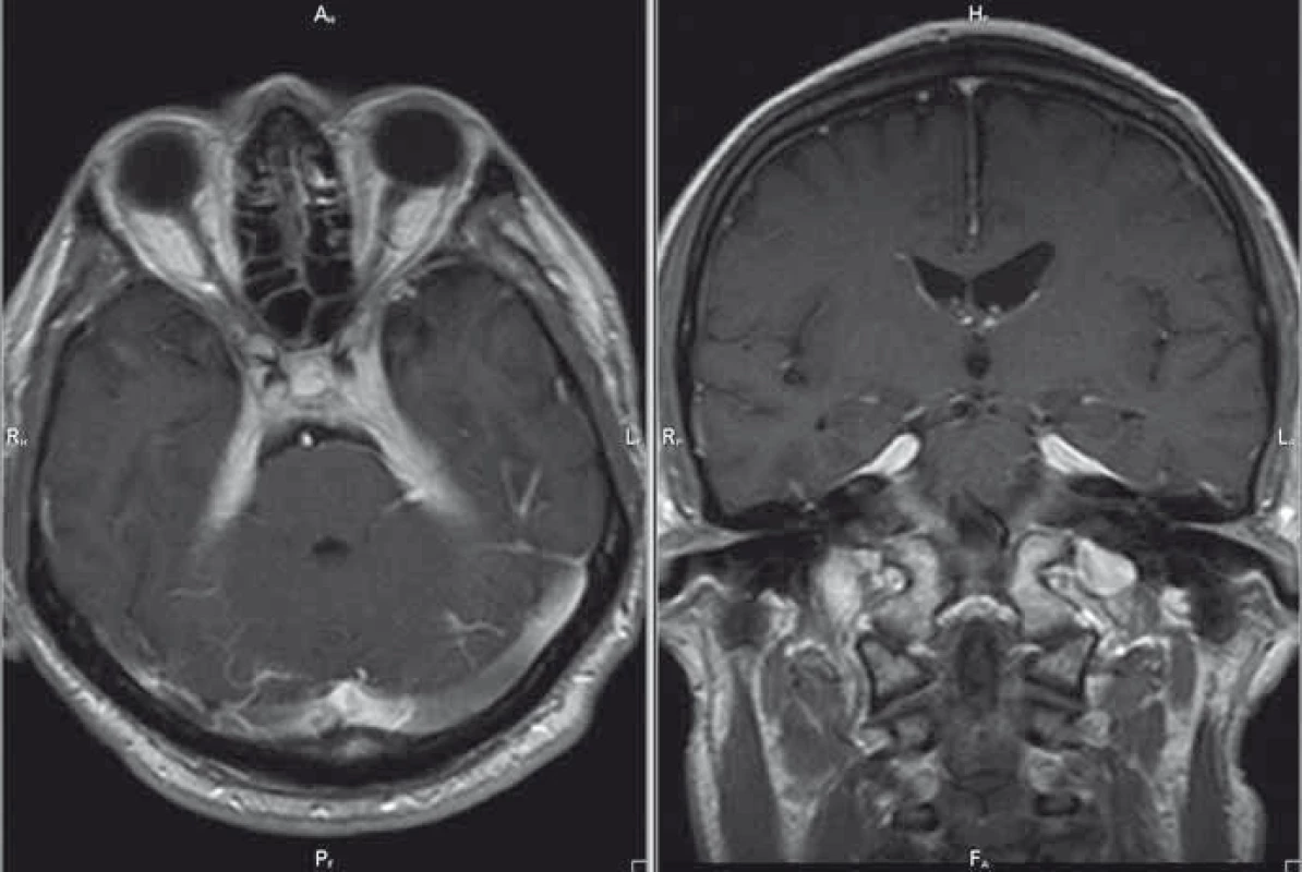 MR mozku, postkontrastní T1 vážené obrazy v axiální/koronární rovině; progrese nálezu – kazuistika 1.
Fig. 2. Brain MRI, contrast-enhanced T1-weighted images in the axial/coronal plane; disease progression – a case report 1.