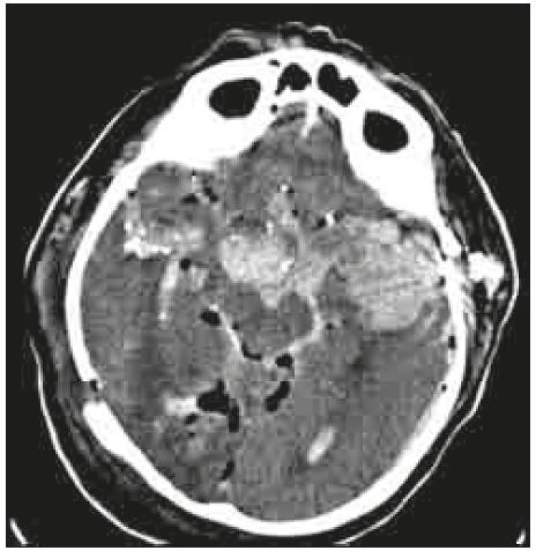Průstřel hlavy a mozku bazálně před mozkovým kmenem.
CT mozku – axiální řez.
