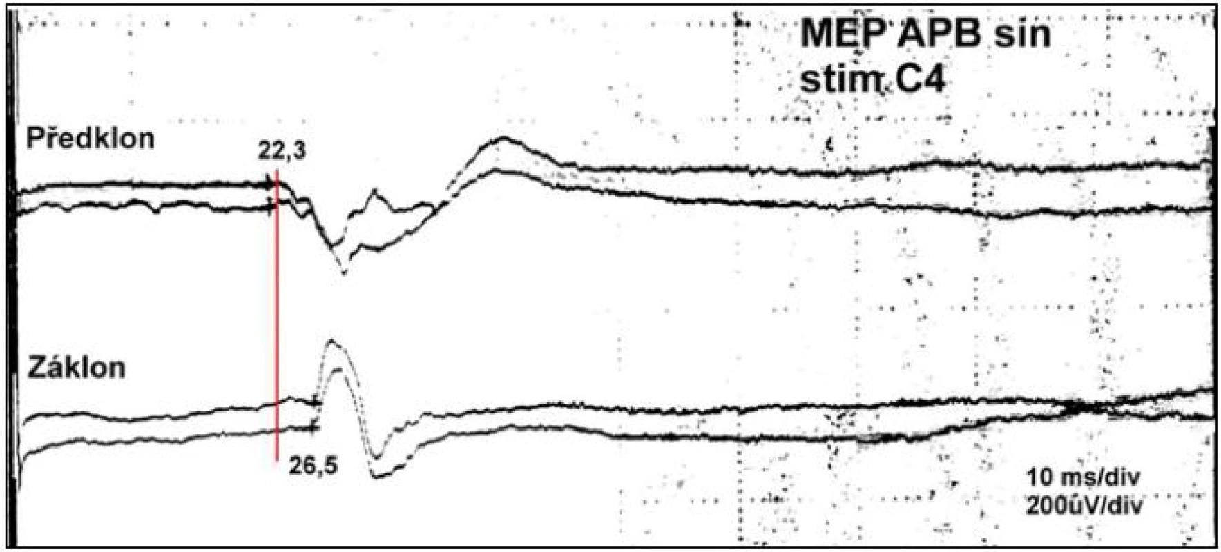 Záznam změny průběhu MEP při předklonu a záklonu u nemocného s RA atlanto-axiálním dislokací 9 mm.