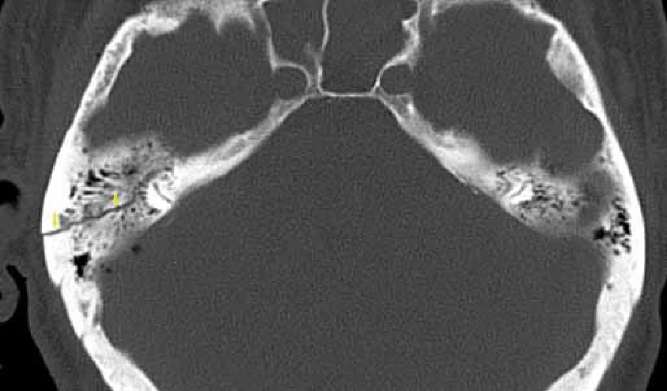Nepetrózní fraktura – mastoidní segment, HRCT, axiální rovina.
Fig. 5. Non-petrous bone fracture (mastoid), HRCT, axial plane.
