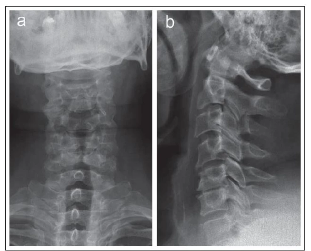 RTG snímek v předozadní (a) a laterální projekci (b) u pacienta s osteochondrózou v segmentech C4–C6, zvláště pokročilou v etáži C5/6.