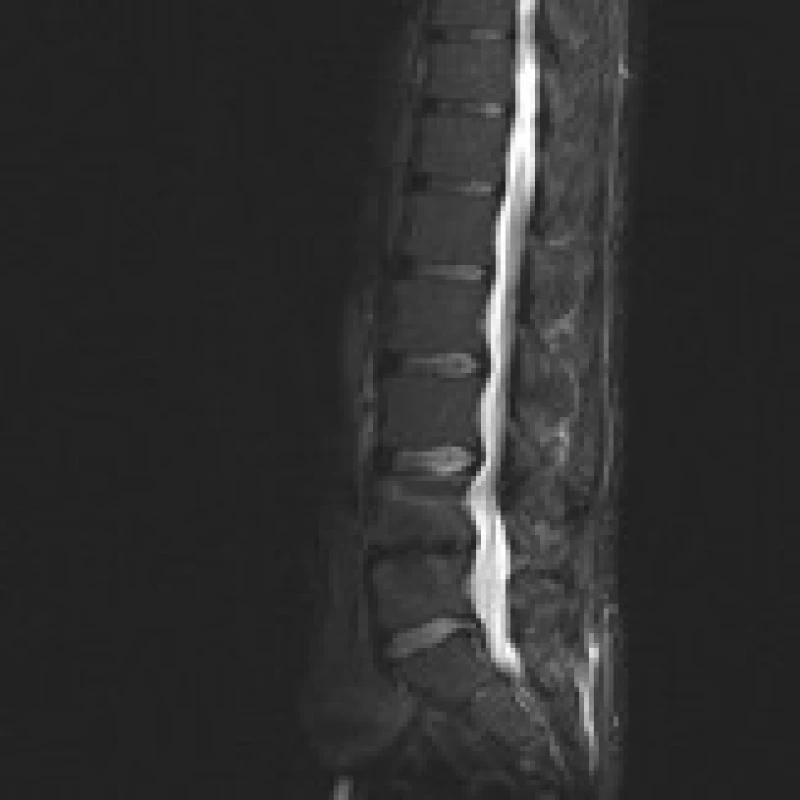 MR šest měsíců po doplnění zadní transpedikulární fixace L4–5 pro selhání ALIF stand- alone (Visios) u stejného pacienta. Vyšetření ve STIR prokazuje vymizení Modicových změn a kostních cyst. Sagitální zobrazení ve střední čáře.
