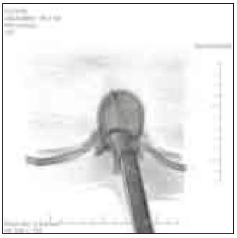Rekonstrukce CT vyšetření zobrazuje trajektorii.
Kuchyňský nůž pronikl zprava zezadu páteřním kanálem a dále dopředu přes tělo 11. hrudního obratle.