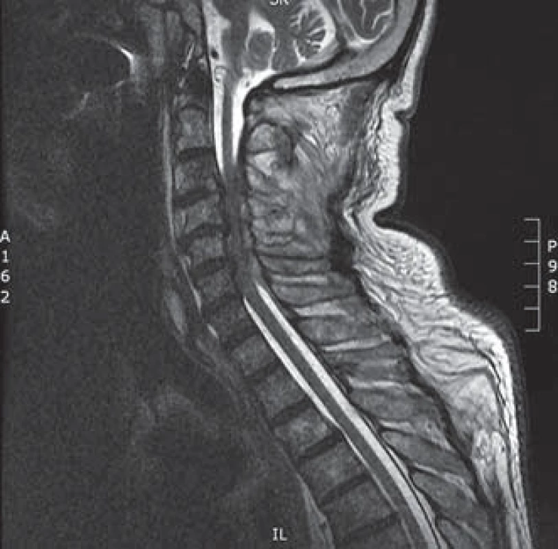 Kazuistika 2 – MR.
Sagitální T2 vážený obraz, lehká krční lordóza, spinální stenóza C3–6, dorzální epidurální abscesy C3–6 s útlakem míchy.