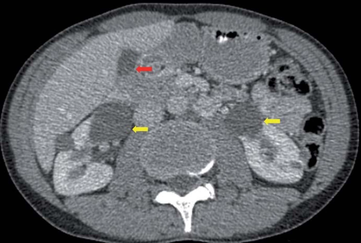 CT dutiny břišní s kontrastem v axiální rovině.
Cystadenomy ledvin (žluté šipky) a pankreatu (červená šipka).