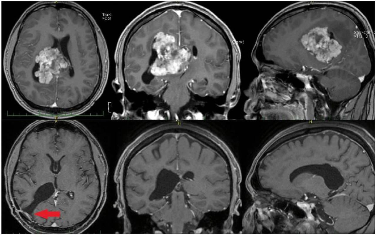 MR mozku pacienta s intraventrikulárním meningiomem, nahoře vstupní, předoperační snímky.
Obrázky dole ukazují stav po radikální exstirpaci. Šipka vlevo dole označuje přístupovou cestu.
