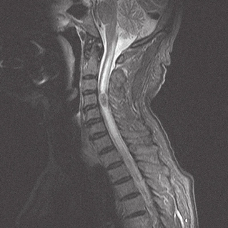 MRI krční páteře v sagitální rovině, ve STIR modu, před operací, na úrovni C4 intramedulární metastáza se syringomyelickou dutinou kraniálně a kaudálně probíhající.