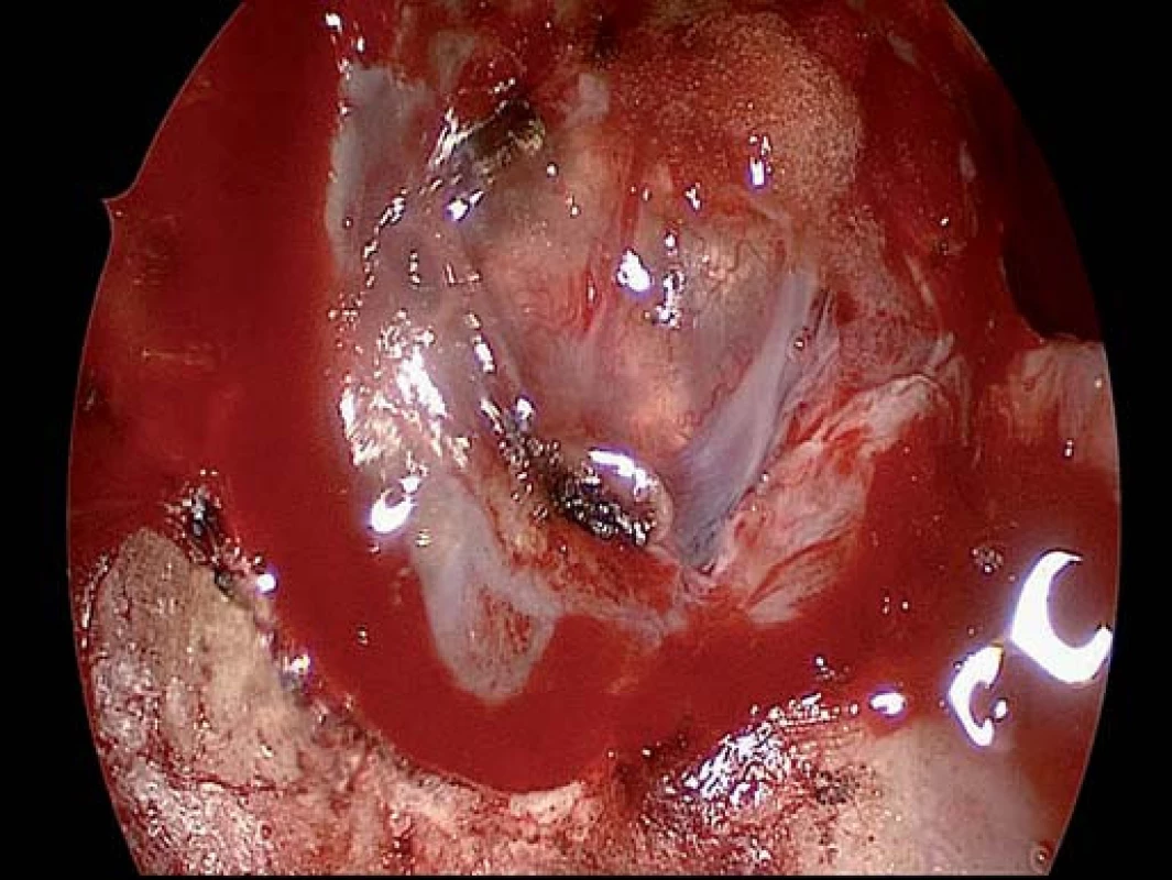 Endoskopický pohled na kraniofaryngeom po otevření tvrdé pleny.